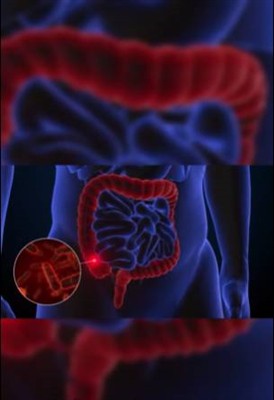 Leuke medische weetjes - Hoe heb je de nierstenen gekregen?